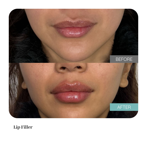 Before and after treatment result — Dr. Lanna, LC Medical Aesthetics NYC